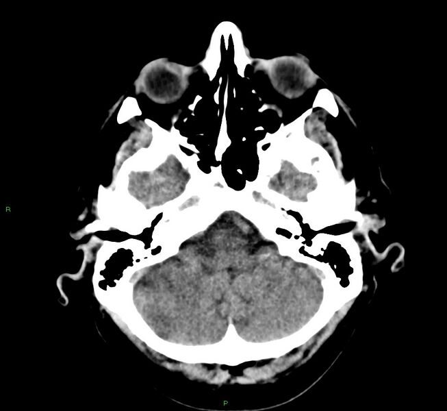 File:Cerebral amyloid angiopathy-associated lobar intracerebral hemorrhage (Radiopaedia 58376-65511 Axial non-contrast 45).jpg