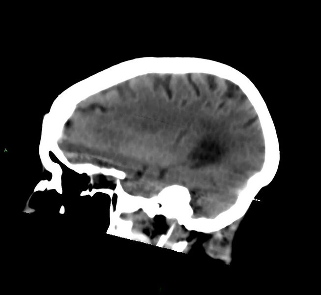 File:Cerebral amyloid angiopathy-associated lobar intracerebral hemorrhage (Radiopaedia 58377-65514 B 36).jpg