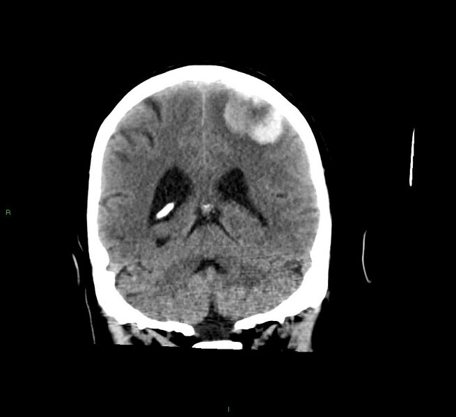 File:Cerebral amyloid angiopathy-associated lobar intracerebral hemorrhage (Radiopaedia 58529-65681 Coronal non-contrast 24).jpg