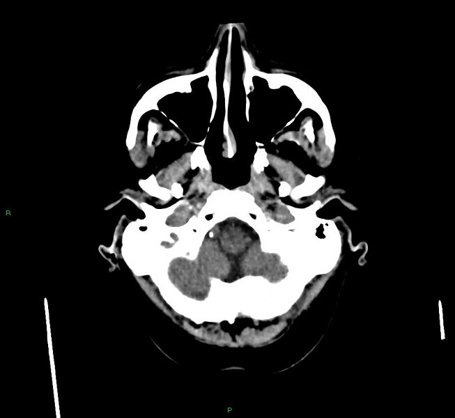 File:Cerebral amyloid angiopathy-associated lobar intracerebral hemorrhage (Radiopaedia 58560-65723 Axial non-contrast 46).jpg