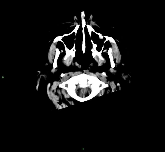 File:Cerebral amyloid angiopathy-associated lobar intracerebral hemorrhage (Radiopaedia 58560-65723 Axial non-contrast 52).jpg