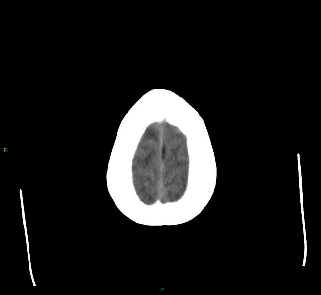 File:Cerebral amyloid angiopathy-associated lobar intracerebral hemorrhage (Radiopaedia 58560-65723 Axial non-contrast 7).jpg