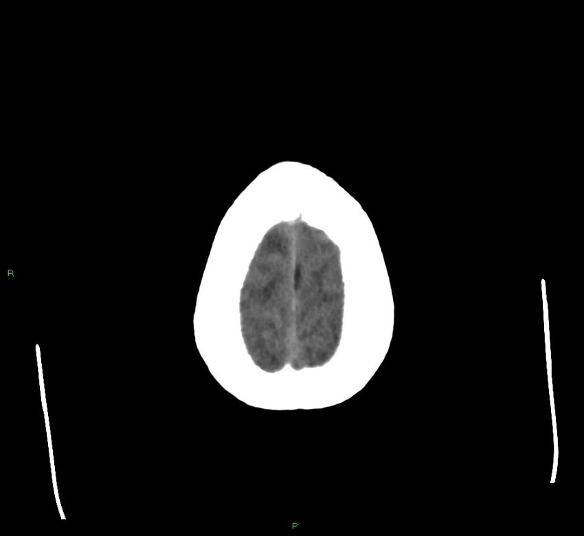 Cerebral amyloid angiopathy-associated lobar intracerebral hemorrhage (Radiopaedia 58560-65723 Axial non-contrast 7).jpg
