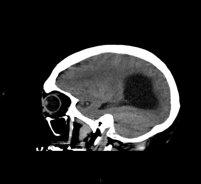 File:Cerebral amyloid angiopathy-associated lobar intracerebral hemorrhage (Radiopaedia 58560-65723 C 37).jpg