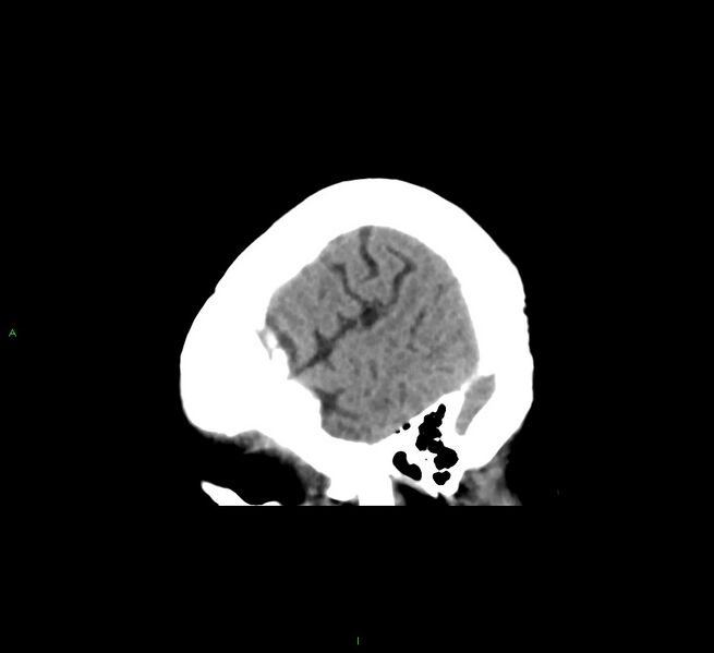 File:Cerebral amyloid angiopathy-associated lobar intracerebral hemorrhage (Radiopaedia 58563-65727 C 45).jpg