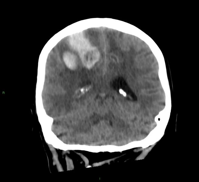 File:Cerebral amyloid angiopathy-associated lobar intracerebral hemorrhage (Radiopaedia 58566-65730 Coronal non-contrast 27).jpg