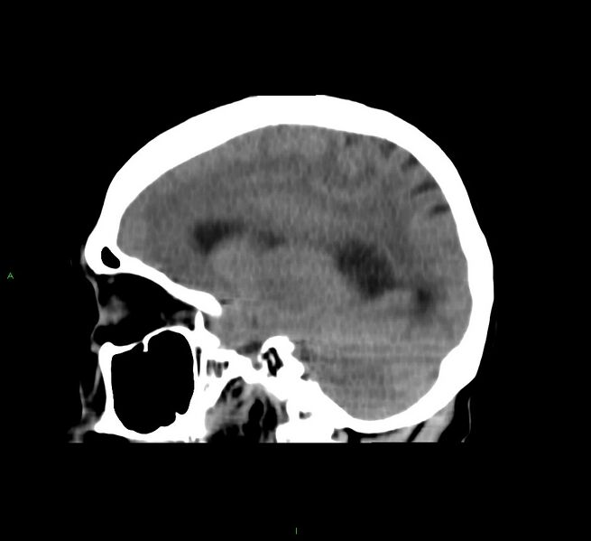 File:Cerebral amyloid angiopathy-associated lobar intracerebral hemorrhage (Radiopaedia 58751-65972 C 35).jpg