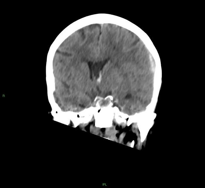 File:Cerebral amyloid angiopathy-associated lobar intracerebral hemorrhage (Radiopaedia 58754-65975 Coronal non-contrast 37).jpg
