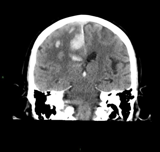File:Cerebral amyloid angiopathy-associated lobar intracerebral hemorrhage (Radiopaedia 59356-66716 Coronal non-contrast 31).jpg