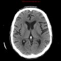 Cerebral and orbital tuberculomas (Radiopaedia 13308-13310 Axial non-contrast 15).jpg