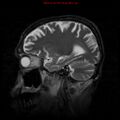 Cerebral and orbital tuberculomas (Radiopaedia 13308-13311 Sagittal T2 14).jpg