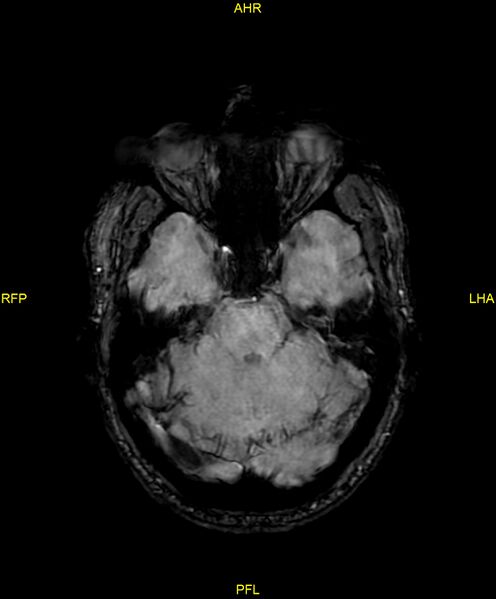 File:Cerebral autosomal dominant arteriopathy with subcortical infarcts and leukoencephalopathy (CADASIL) (Radiopaedia 86108-102054 Axial SWI 36).jpg