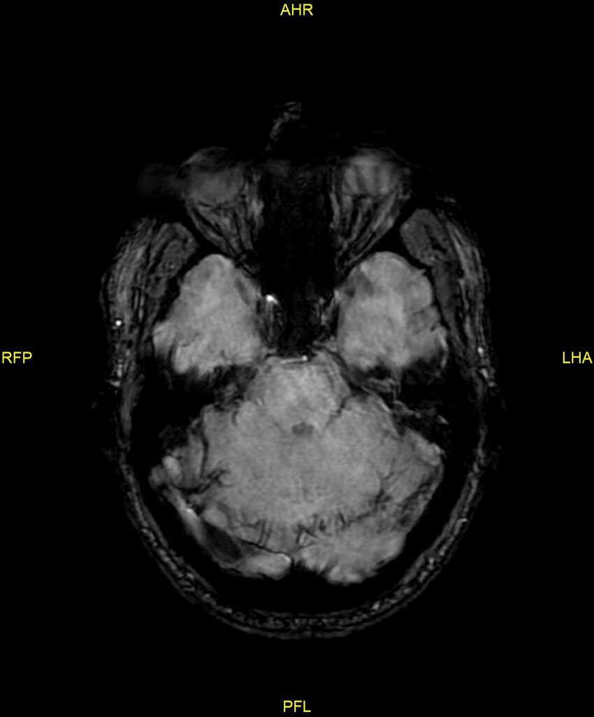 Cerebral autosomal dominant arteriopathy with subcortical infarcts and leukoencephalopathy (CADASIL) (Radiopaedia 86108-102054 Axial SWI 36).jpg