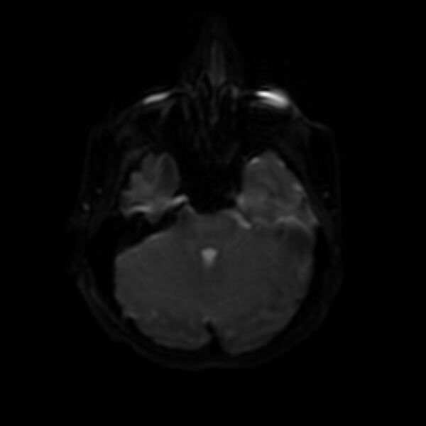 File:Cerebral fat embolism (Radiopaedia 37510-39363 Axial DWI 32).jpg