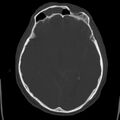 Cerebral hemorrhagic contusions (Radiopaedia 23145-23188 Axial bone window 25).jpg