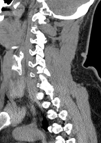File:Cerebral hemorrhagic contusions and cervical spine fractures (Radiopaedia 32865-33841 G 44).jpg
