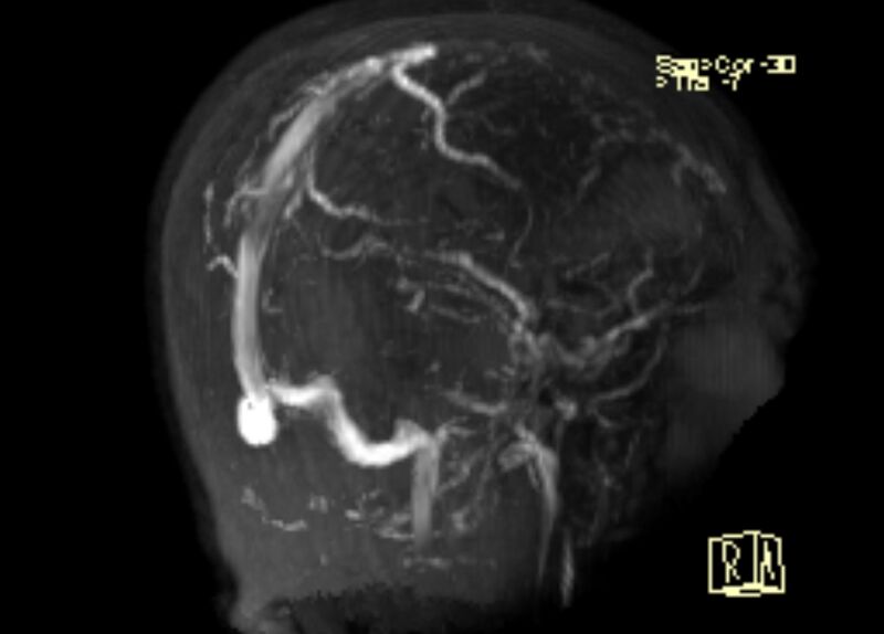 File:Cerebral venous infarct (Radiopaedia 53627-59723 3D MRV 15).jpg