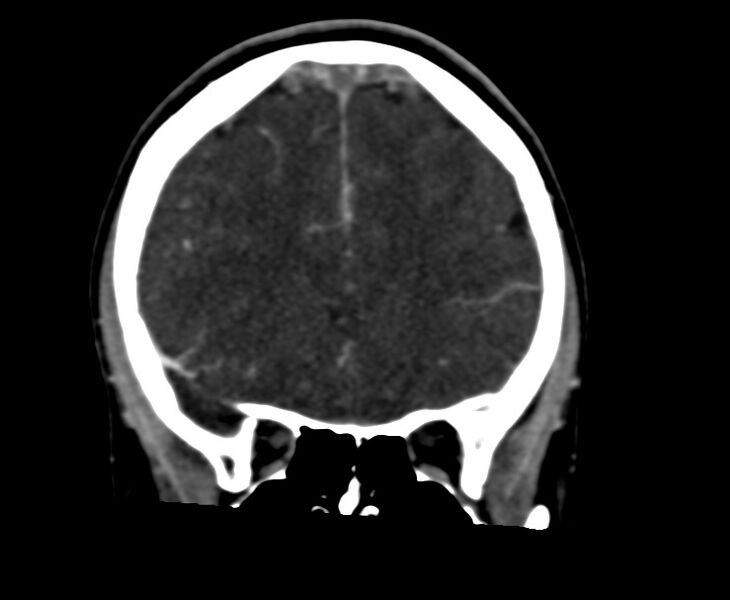 File:Cerebral venous sinus thrombosis (Radiopaedia 59224-66646 Coronal C+ delayed 22).jpg