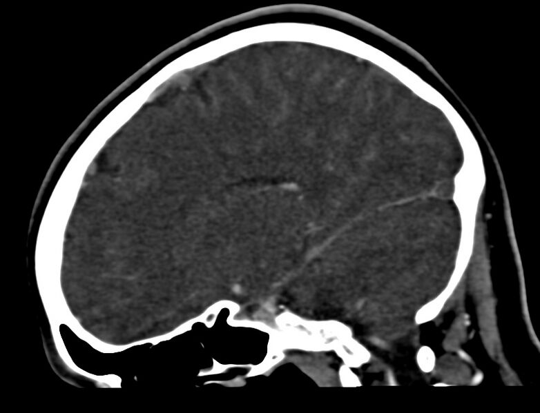File:Cerebral venous sinus thrombosis (Radiopaedia 59224-66646 Sagittal C+ delayed 34).jpg