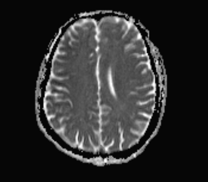 File:Cerebral venous thrombosis (Radiopaedia 71207-81504 Axial ADC 13).jpg
