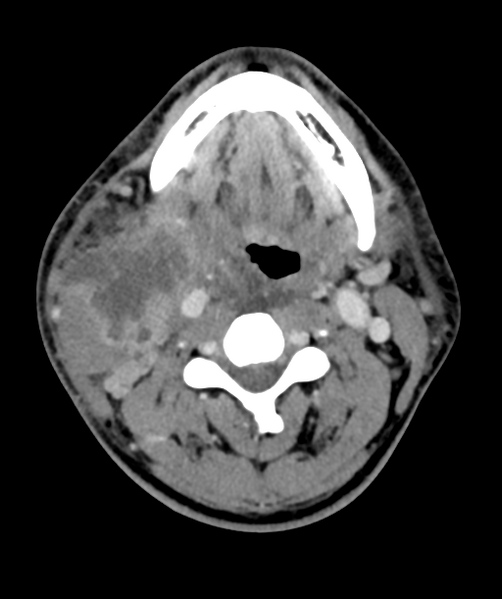 File:Cervical abscess (Radiopaedia 43725-47184 A 30).png