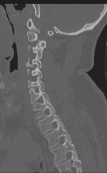 File:Cervical canal stenosis - OPLL and osteophytes (Radiopaedia 47329-51910 Sagittal bone window 29).png