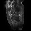 Cervical carcinoma (Radiopaedia 78847-91705 I 2).jpg