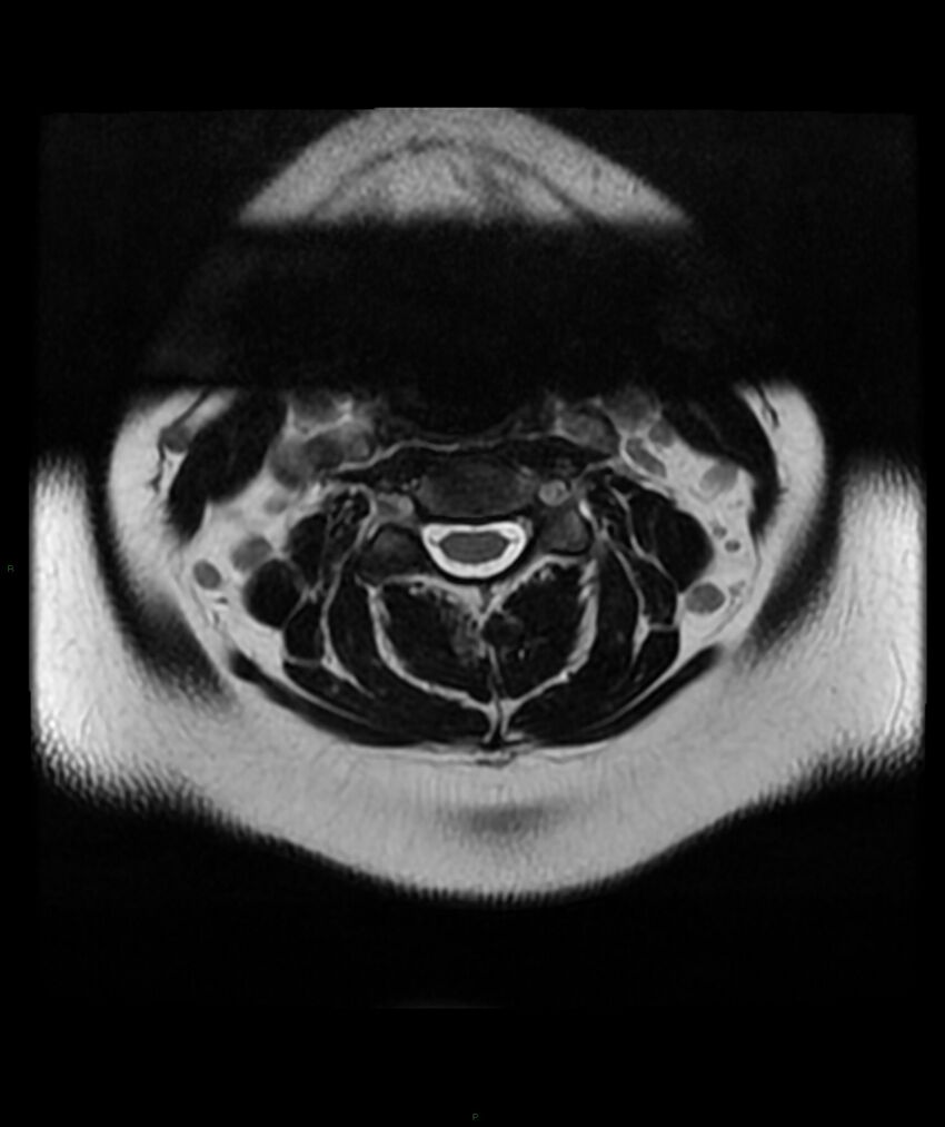 Cervical disc prolapse (Radiopaedia 80258-93598 Axial T2 12).jpg