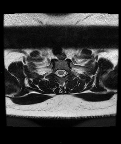 File:Cervical disc prolapse (Radiopaedia 80258-93598 Axial T2 82).jpg