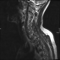 Cervical dural CSF leak on MRI and CT treated by blood patch (Radiopaedia 49748-54995 Sagittal T2 11).png