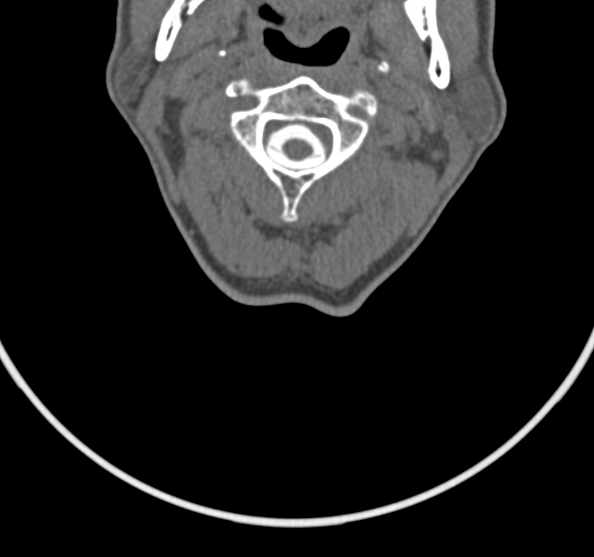 Cervical dural CSF leak on MRI and CT treated by blood patch (Radiopaedia 49748-54996 B 21).png