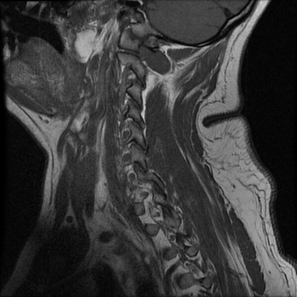 File:Cervical fracture and dislocation with locked facet (Radiopaedia 31837-32781 Sagittal T1 14).jpg