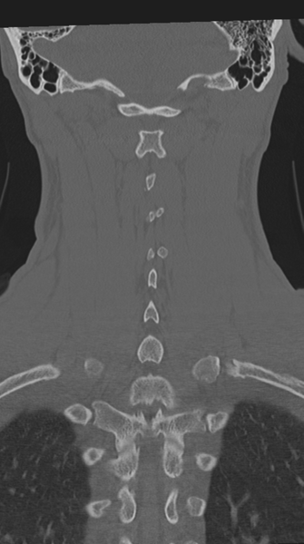 File:Cervical intercalary bone (Radiopaedia 35211-36748 Coronal bone window 56).png