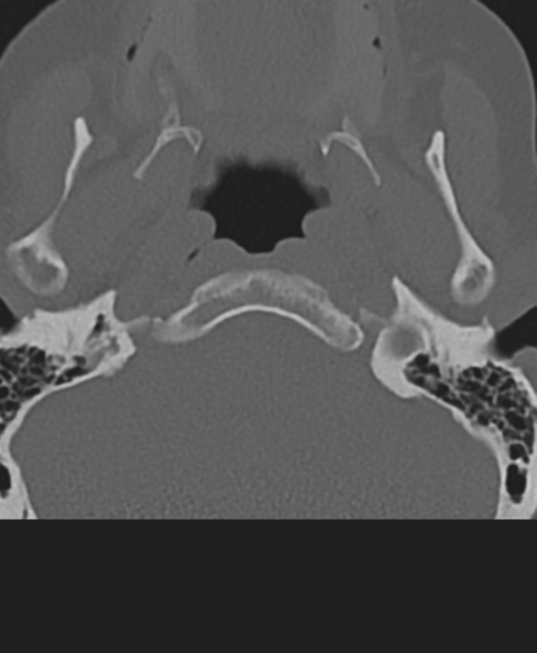 File:Cervical spine ACDF loosening (Radiopaedia 48998-54071 Axial bone window 6).png