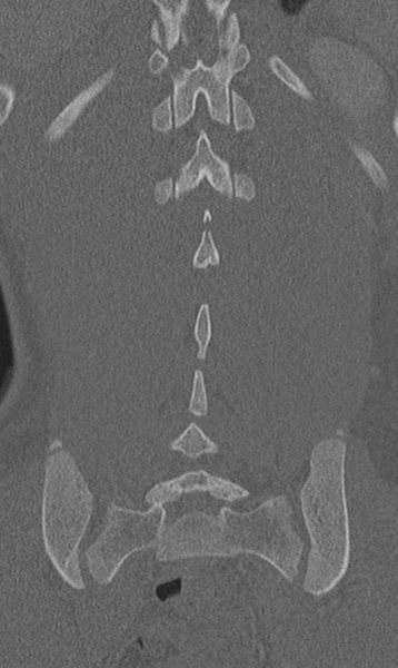 File:Chance fracture (Radiopaedia 40360-42912 Coronal bone window 54).png
