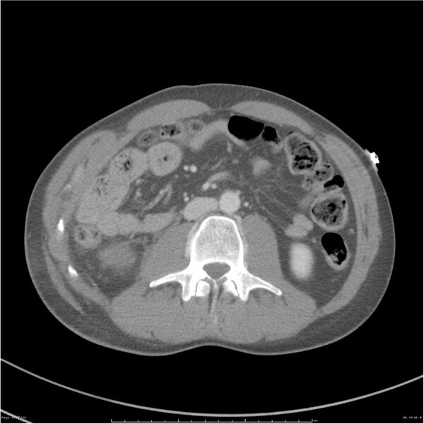 File:Chest and abdomen multi-trauma (Radiopaedia 26294-26426 A 44).jpg