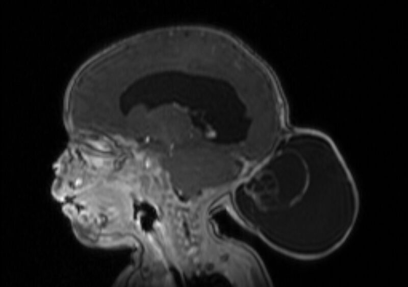 File:Chiari III malformation with occipital encephalocele (Radiopaedia 79446-92559 Sagittal T1 C+ mpr 31).jpg