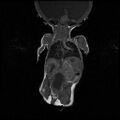 Chiari II malformation with spinal meningomyelocele (Radiopaedia 23550-23652 Coronal T1 2).jpg