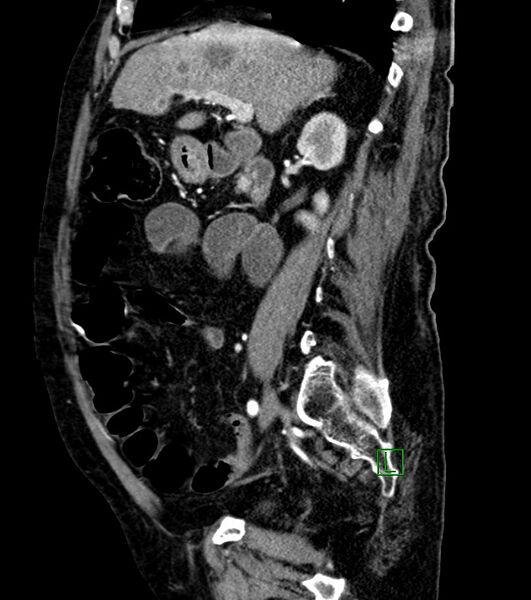 File:Cholangiocarcinoma with cerebral metastases (Radiopaedia 83519-98629 F 76).jpg