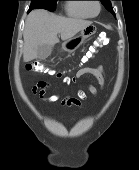 File:Cholecystitis with focal perforation and hepatic abscess (Radiopaedia 37189-38945 Coronal non-contrast 15).png