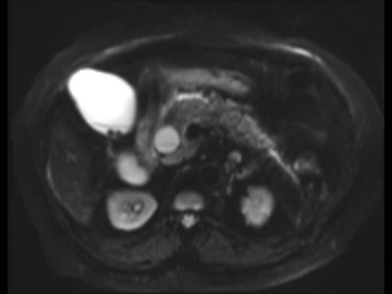 File:Choledocholithiasis causing intrahepatic biliary duct dilation (Radiopaedia 39908-42369 Axial T2 SPAIR 14).jpg