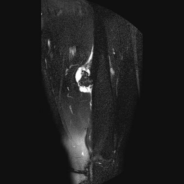 File:Chondrosarcoma arising from exostosis (Radiopaedia 59996-67686 C 9).jpg