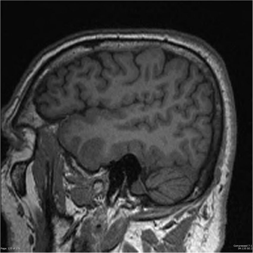Chondrosarcoma of skull base- grade II (Radiopaedia 40948-43654 Sagittal T1 58).jpg