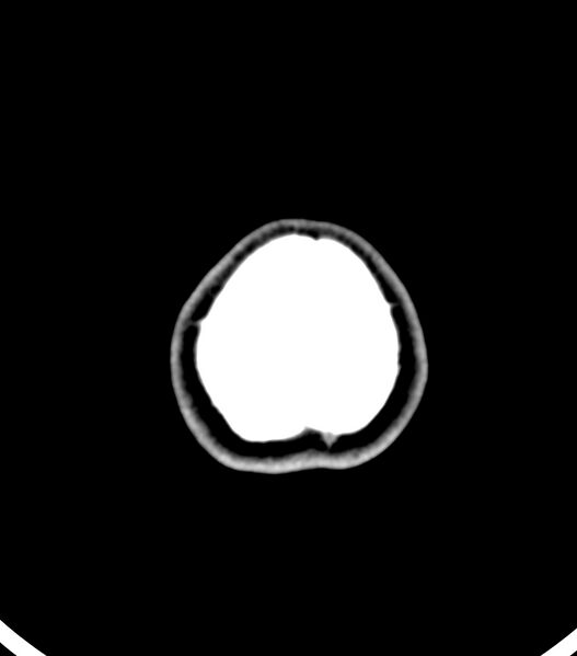 File:Choroid plexus carcinoma (Radiopaedia 91013-108552 Axial non-contrast 59).jpg