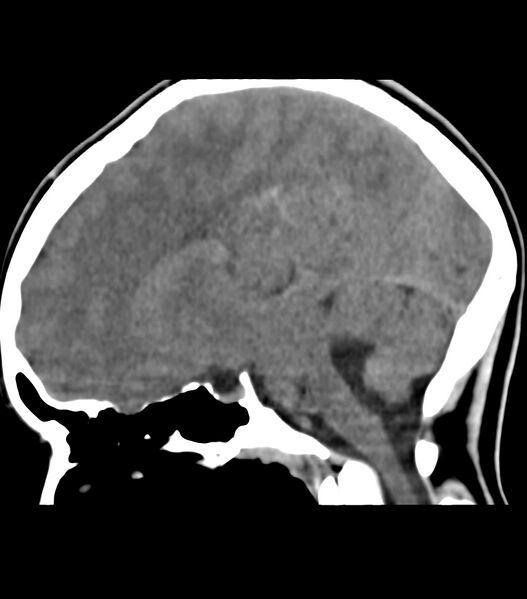 File:Choroid plexus carcinoma (Radiopaedia 91013-108552 B 39).jpg