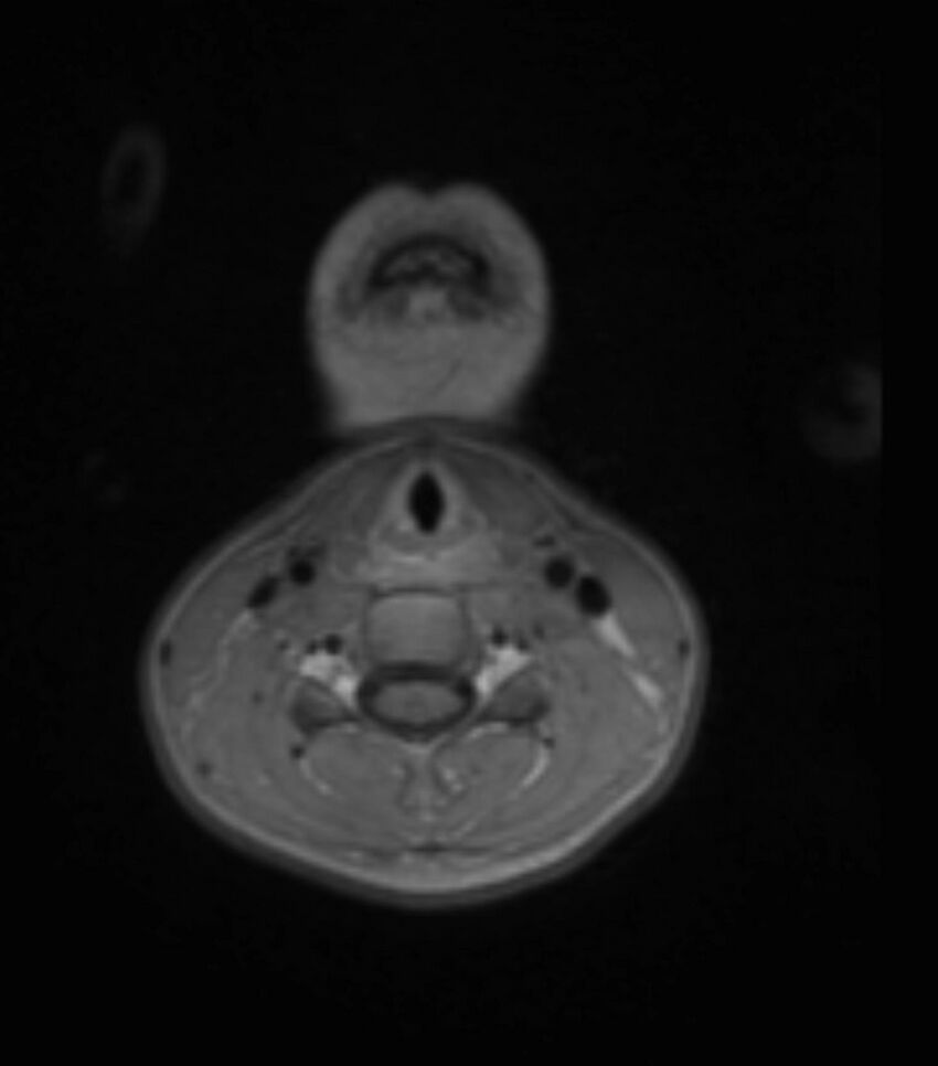 Choroid plexus carcinoma (Radiopaedia 91013-108553 Axial T1 C+ 6).jpg