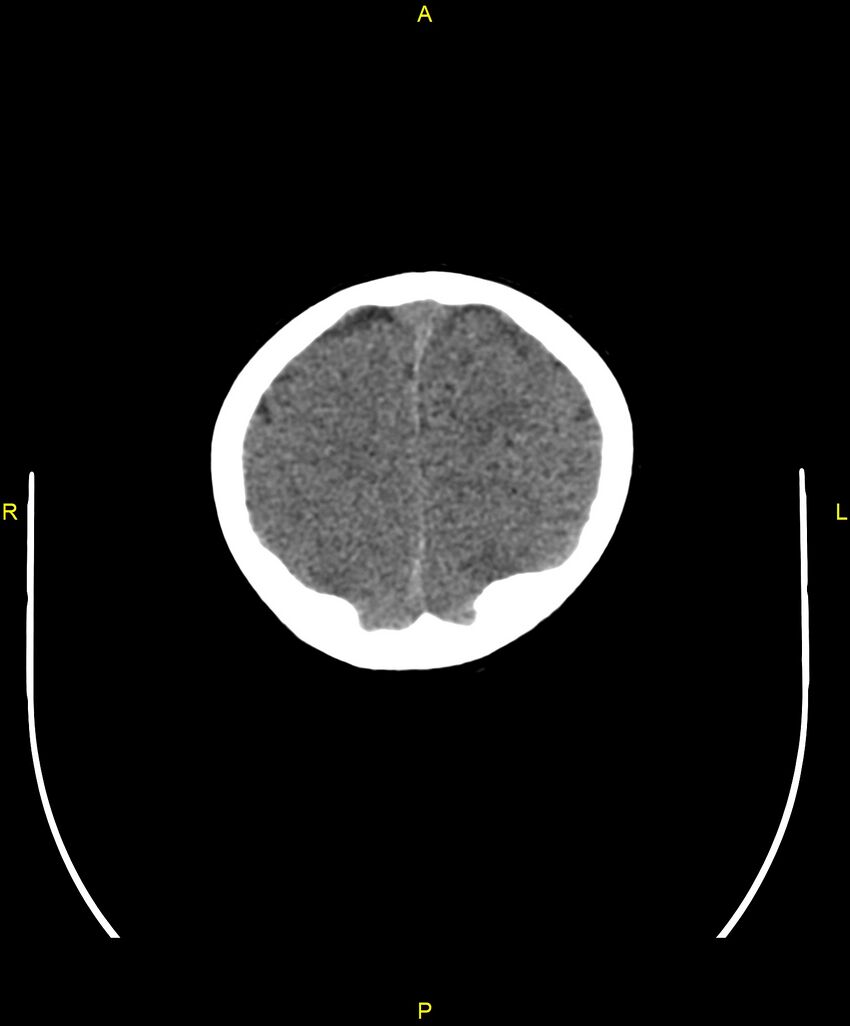 Choroidal fissure cyst (Radiopaedia 89481-106465 Axial non-contrast 105).jpg