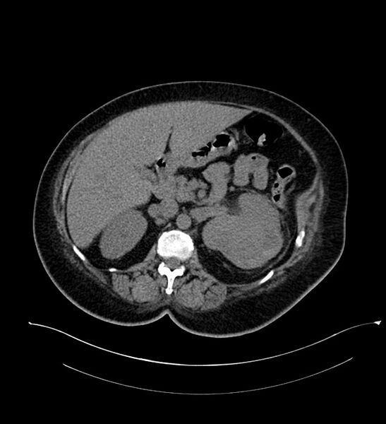 File:Chromophobe renal cell carcinoma (Radiopaedia 84239-99519 Axial non-contrast 67).jpg
