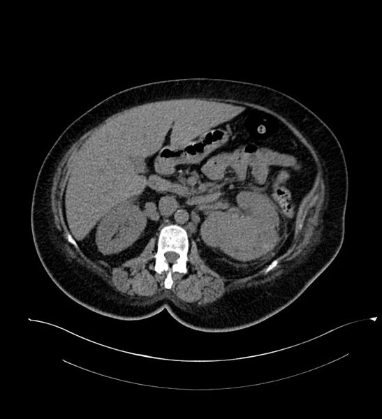 File:Chromophobe renal cell carcinoma (Radiopaedia 84239-99519 Axial non-contrast 70).jpg