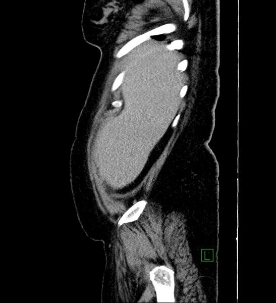 File:Chromophobe renal cell carcinoma (Radiopaedia 84239-99519 G 103).jpg